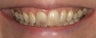 Porcelain crowns and porcelain veneers
