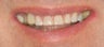 Porcelain crowns and porcelain veneers