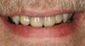 Porcelain veneers