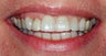 Orthodontics, all porcelain veneers