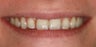 Orthodontics, all porcelain veneers