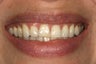 Porcelain veneers