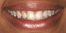 Porcelain veneers