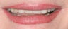 Porcelain veneers