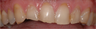 Porcelain Veneers