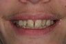 Vaneers and whitening