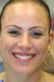veneer and crown correction