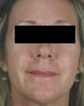 Pulsed Dye Laser Treatments for Rosacea