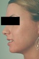 Pulsed Dye Laser Treatment for Acne/Rosacea