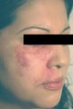 Port Wine Birthmark Removal with Pulsed Dye Lasers