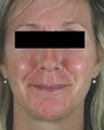 Pulsed Dye Laser Treatments for Rosacea