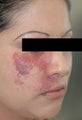 Port Wine Birthmark Removal with Pulsed Dye Lasers