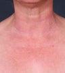 Vbeam (PDL) for chest