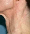 PDL treatment on neck