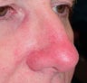 PDL for nose veins