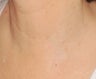 PDL for port wine stain