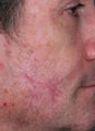 PDL scar treatment