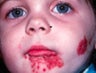 PDL for port wine stain