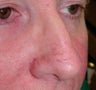 PDL for nose veins
