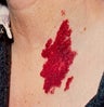 PDL for port wine stain