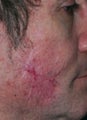 PDL scar treatment