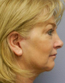 Quicklift (Lower Face/Neck Lift with Chin Aug)