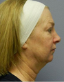 Quicklift (Lower Face/Neck Lift with Chin Aug)