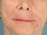 Radiesse/Juvederm