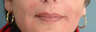 Radiesse/Juvederm