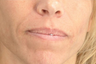 Radiesse/Juvederm