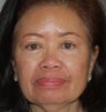 Upper Lid Blepharoplasty & NS Cheek Enhancement (Radiesse)