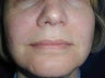 Radiesse treatment