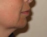 Injectables