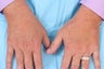 Radiesse for Hand Rejuvenation