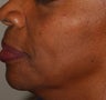 Radiesse Treatment