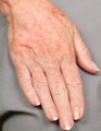 Radiesse treatment for hand rejuvenation