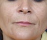 Radiesse treatment for nasolabial folds