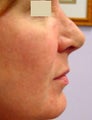Radiesse Cheek Lift