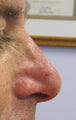 Filler Nose Job