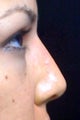 Lunch Time Nose Job using Radiesse