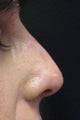 Nasal Tip created using Radiesse