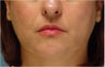 Radiesse injection nasolabial folds and marionette lines