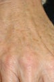 Radiesse hand injection