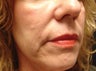 Radiesse Injection into the Cheeks and Nasolabial Folds