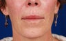 Nasolabial fold correction