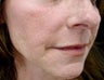 Mid Face and Lip Correction