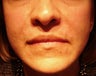 Nasolabial Fold Treatment