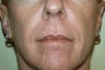 Radiesse and Juvederm XC