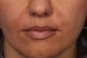 Radiesse to Smile Lines (nasolabial folds)