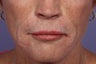 Radiesse and Juvederm - Smile lines